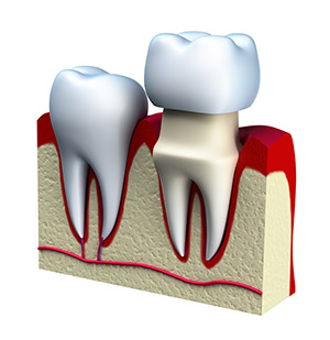 Advanced Dental Practices one day crowns