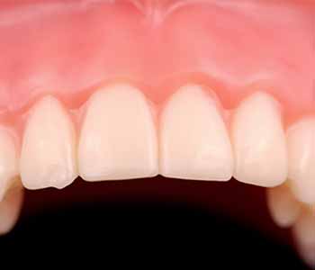 patients seeking the best replacement for missing teeth