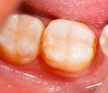 gingivitis treatment from dentist in Wrentham