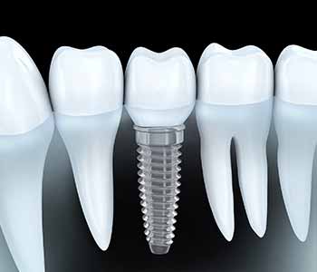 Wrentham area dentist explains the importance of dental implant