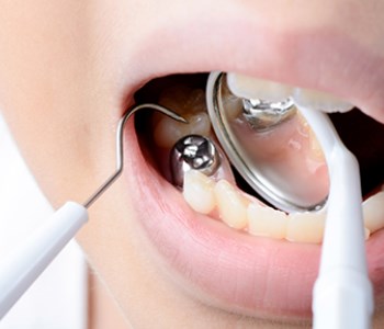 mercury dental filling on tooth removal