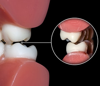 Teeth Grinding Remedy Wrentham MA