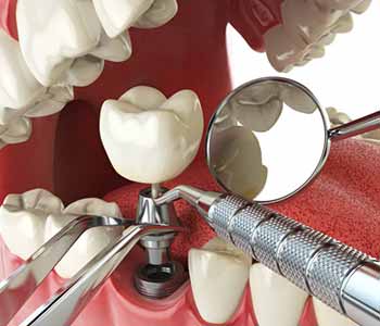 Dental Implant Cost Near Wrentham MA - Missing Teeth Solution