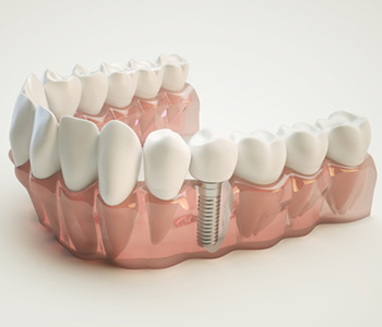 Why You Should Consider Dental Implants in Wrentham, MA area