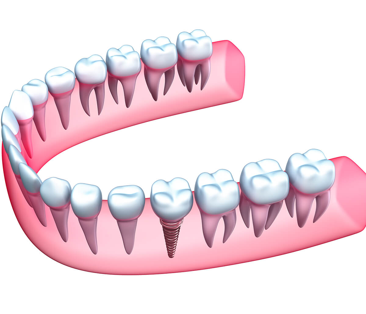 Dentist For Implants Advanced Dental Practices in Wrentham, MA Area