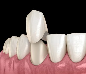 CEREC Dental Crown in Wrentham MA