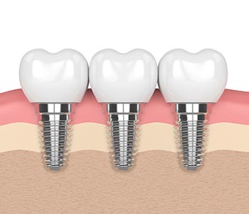 Top Dentist for Dental Implants in Wrentham, MA Area