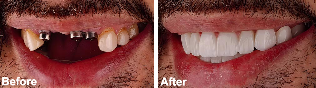 Dental Implants before After Image