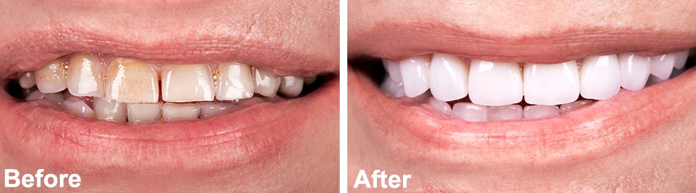 Dental Veneers Before After Image