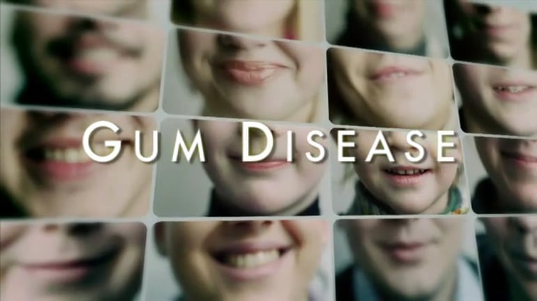 Dental Educational Video on Gum Disease