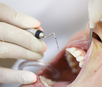 Periodontal Disease at Advanced Dental Practices, Wrentham, MA