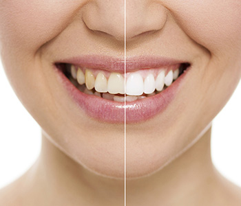 Teeth Whitening at Advanced Dental Practices, Wrentham, MA